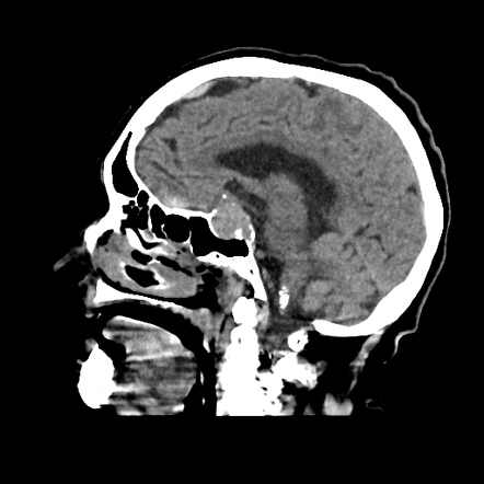 Traumatic intracranial hemorrhage with incidental carotid ...