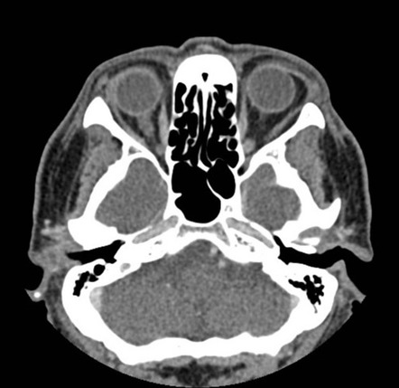 Subconjunctival fat prolapse | Radiology Reference Article ...