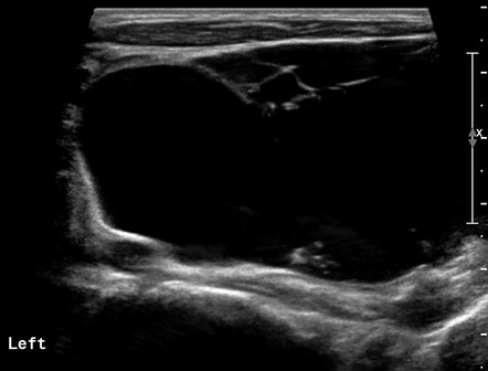 Cystic hygroma | Image | Radiopaedia.org