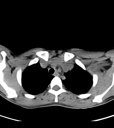 Cystic hygroma | Image | Radiopaedia.org