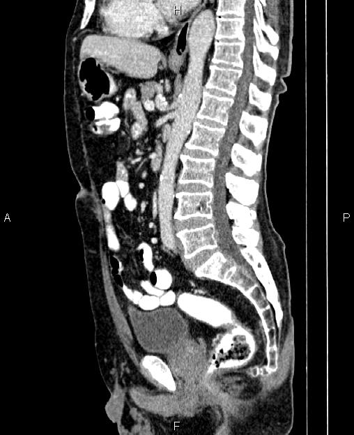 Locally advanced colon cancer | Image | Radiopaedia.org