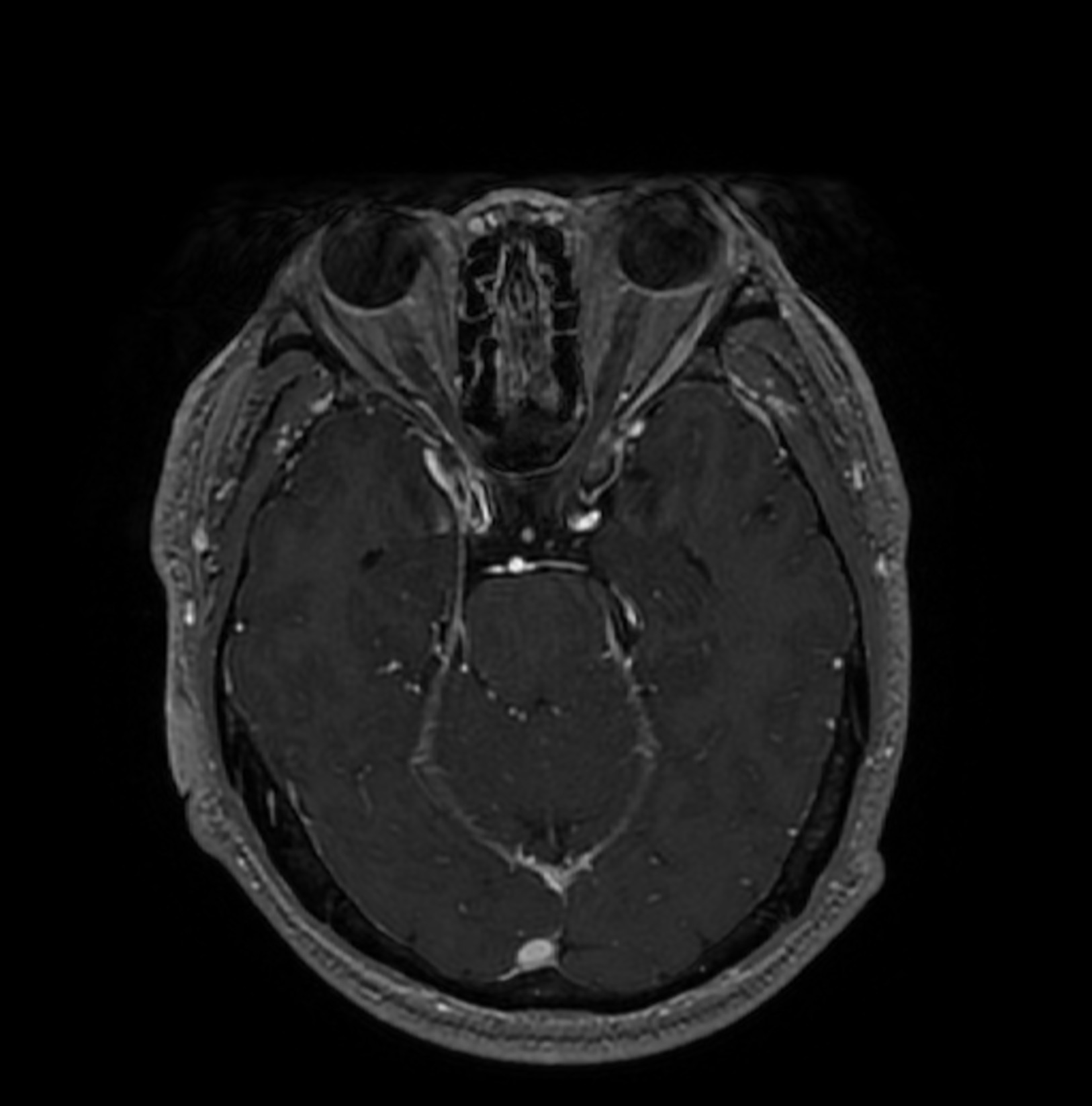 Facial colliculus syndrome | Image | Radiopaedia.org