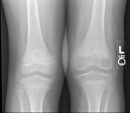 Haemophilic arthropathy | Radiology Reference Article | Radiopaedia.org