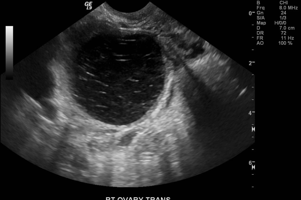 Hemorrhagic Ovarian Cyst Ultrasound Hot Sex Picture 