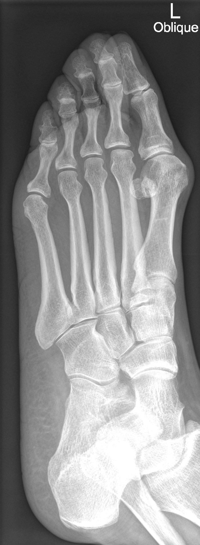 Bunion and bunionette deformity | Image | Radiopaedia.org