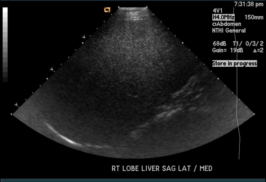 Hepatic fatty infiltration | Image | Radiopaedia.org