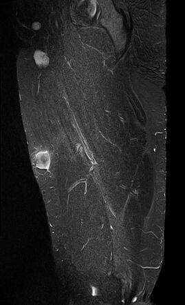 Nodular fasciitis | Image | Radiopaedia.org