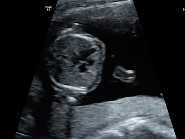 Second-degree atrioventricular block (fetal echocardiography