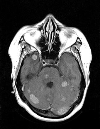 Brain Metastases From Breast Carcinoma | Radiology Case | Radiopaedia.org