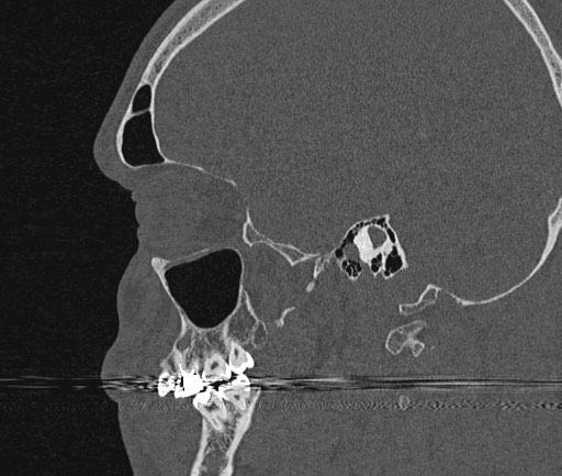 Pneumatized petrous apex | Image | Radiopaedia.org