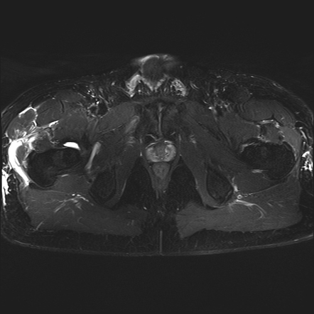 Displaced Acetabular Labral Tear | Image | Radiopaedia.org