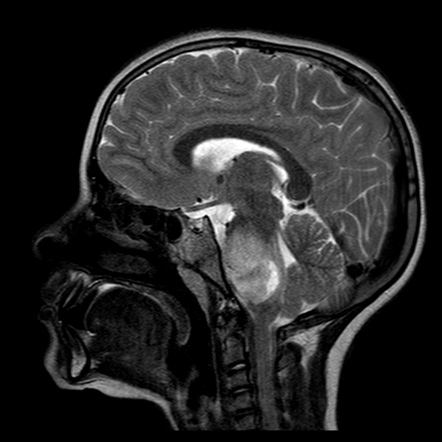 Diffuse midline glioma NOS | Image | Radiopaedia.org