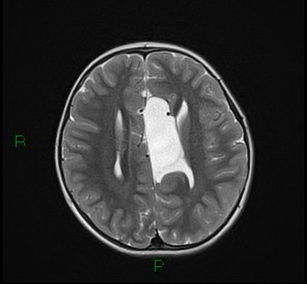 Asymmetric ventriculomegaly, interhemispheric cyst and dysgenesis of ...