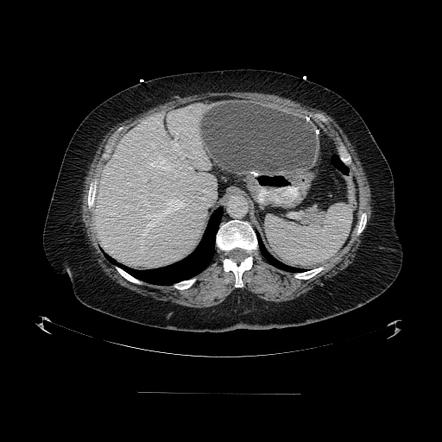 Afferent Limb Obstruction - Pyloric Adenocarcinoma 