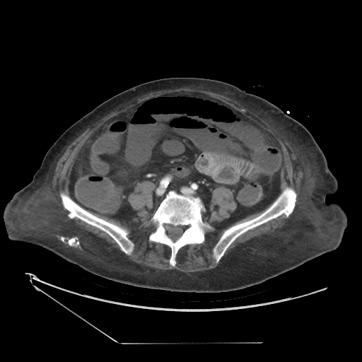 Small bowel ischemia due to SMA embolus | Image | Radiopaedia.org