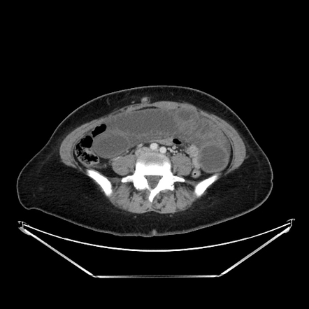 Afferent loop syndrome due to internal hernia and closed-loop ...