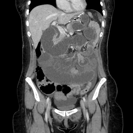 Afferent loop syndrome due to internal hernia and closed-loop ...