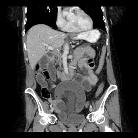 Closed Loop Small Bowel Obstruction - Adhesions | Radiology Case ...