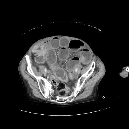 Malignant small bowel obstruction - cecal adenocarcinoma | Radiology ...