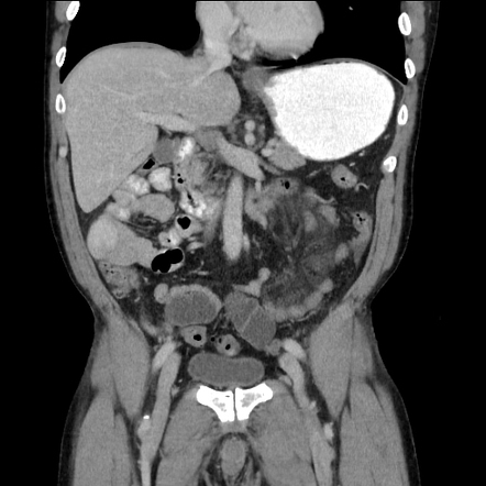 Closed loop small bowel obstruction - internal hernia | Radiology Case ...