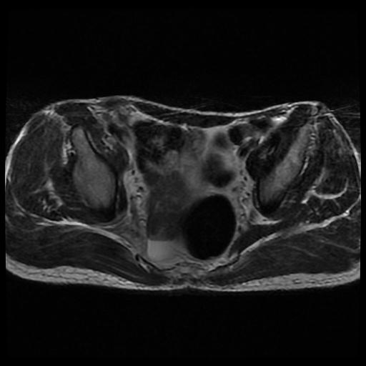 Iliopsoas hematoma | Image | Radiopaedia.org