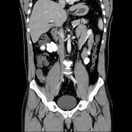 Appendiceal mucocele | Image | Radiopaedia.org