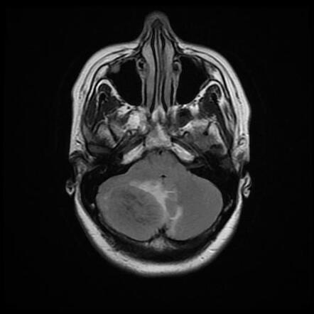 Brain metastasis from breast carcinoma | Radiology Case | Radiopaedia.org