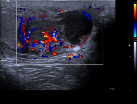 Epididymal Abscess Ultrasound