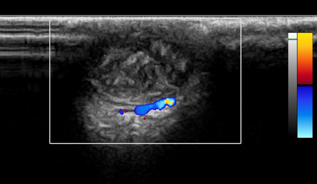 Trichilemmal Cyst Image