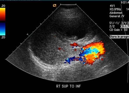 Hydatid cyst | Image | Radiopaedia.org