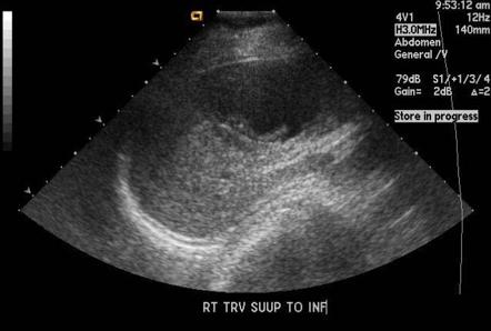 Hydatid cyst | Image | Radiopaedia.org