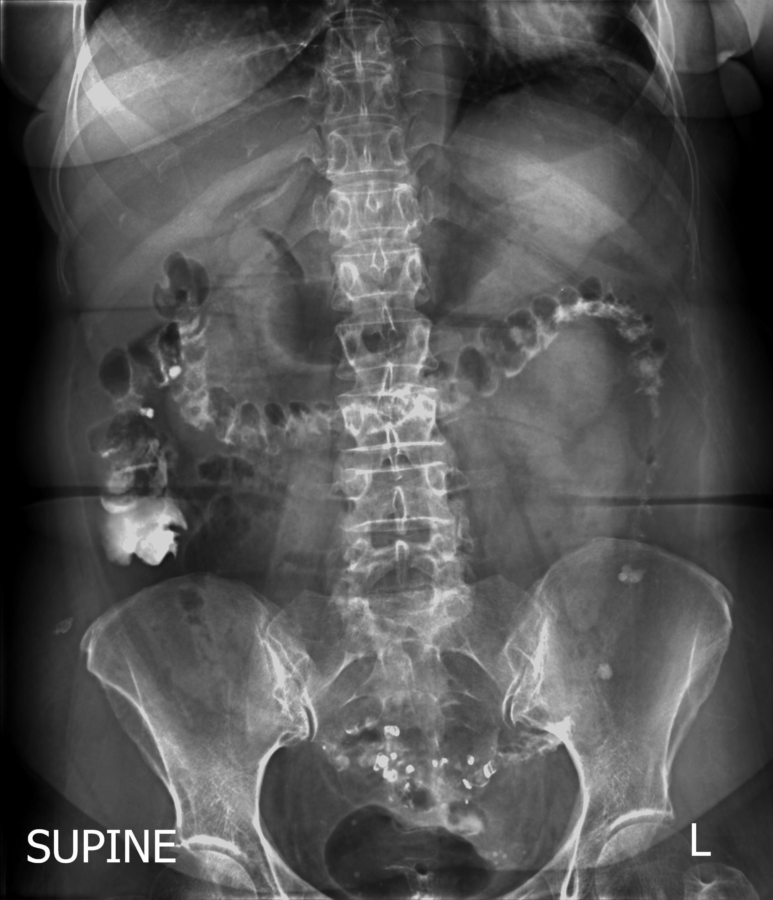 Complicated Sigmoid Diverticulitis With Colovesical Fistula Image 6514