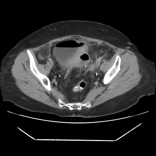 Complicated Sigmoid Diverticulitis With Colovesical Fistula Image 9144