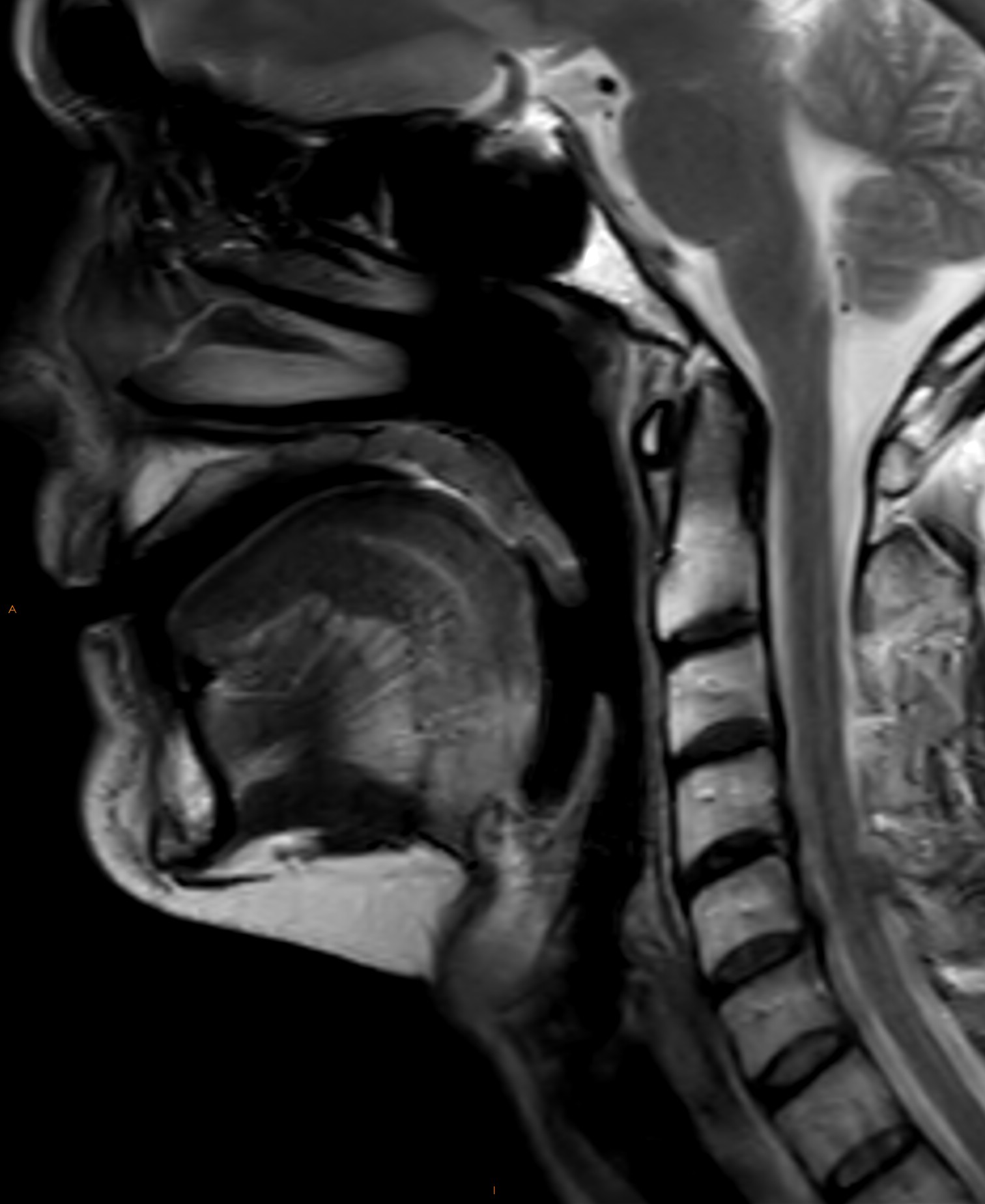 Normal Neck Mri Image