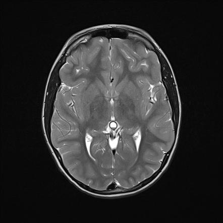 Pineal cyst with hemorrhage | Radiology Case | Radiopaedia.org