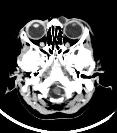 Internal angular dermoid cyst | Image | Radiopaedia.org