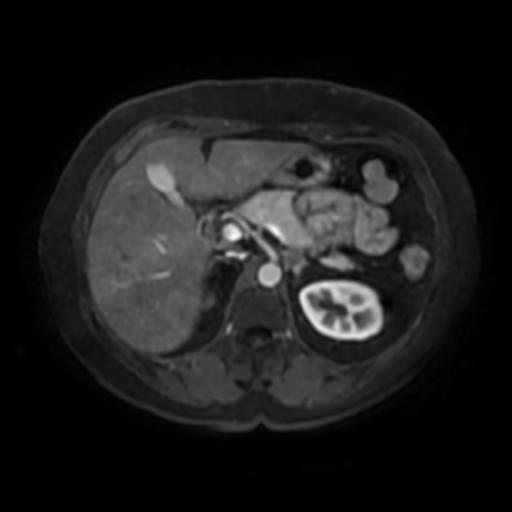 Adrenal adenoma | Image | Radiopaedia.org