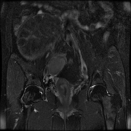 Uterine Fibroid And Bilateral Endometrioma Cysts 