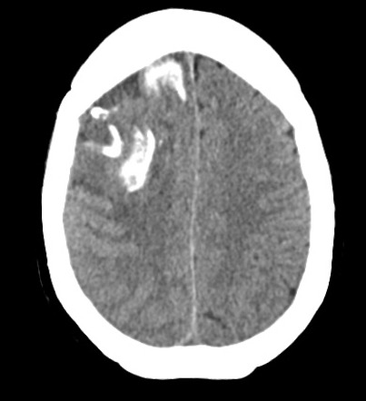 Oligodendroglioma | Radiology Case | Radiopaedia.org