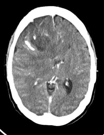 Oligodendroglioma | Image | Radiopaedia.org