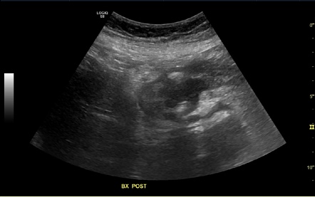 Afferent limb obstruction - pyloric adenocarcinoma | Image ...