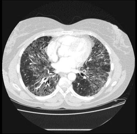 Idiopathic interstitial pneumonia (mnemonic) | Radiology Reference ...