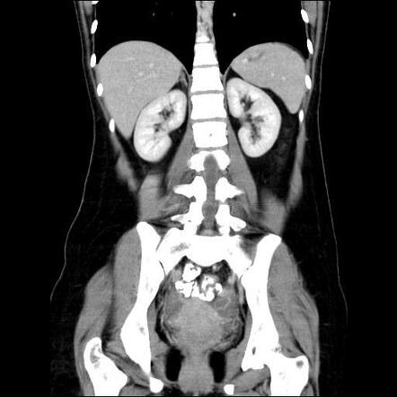 Acute Appendicitis | Radiology Case | Radiopaedia.org