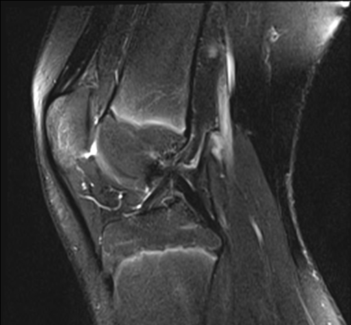 Adventitial bursitis secondary to a distal femoral osteochondroma ...