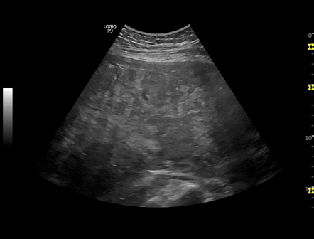 Diffuse uterine leiomyomatosis | Image | Radiopaedia.org