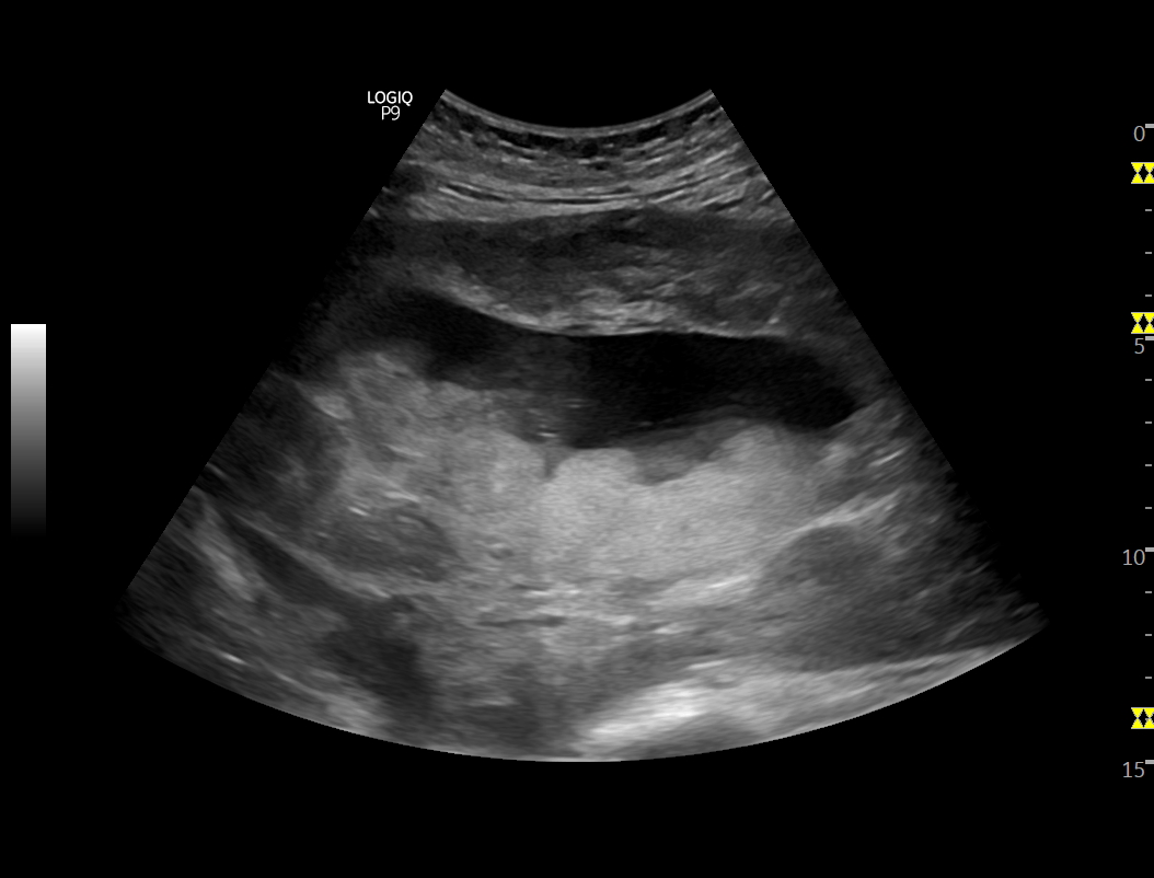 Diffuse uterine leiomyomatosis | Image | Radiopaedia.org