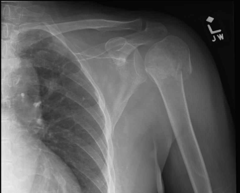 Incidental lung cancer detection | Image | Radiopaedia.org