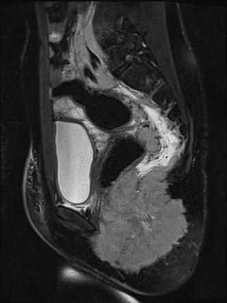 Embryonal rhabdomyosarcoma | Image | Radiopaedia.org