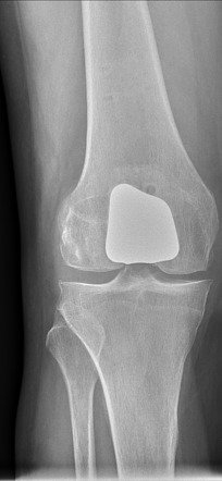 Patellofemoral arthroplasty | Radiology Case | Radiopaedia.org