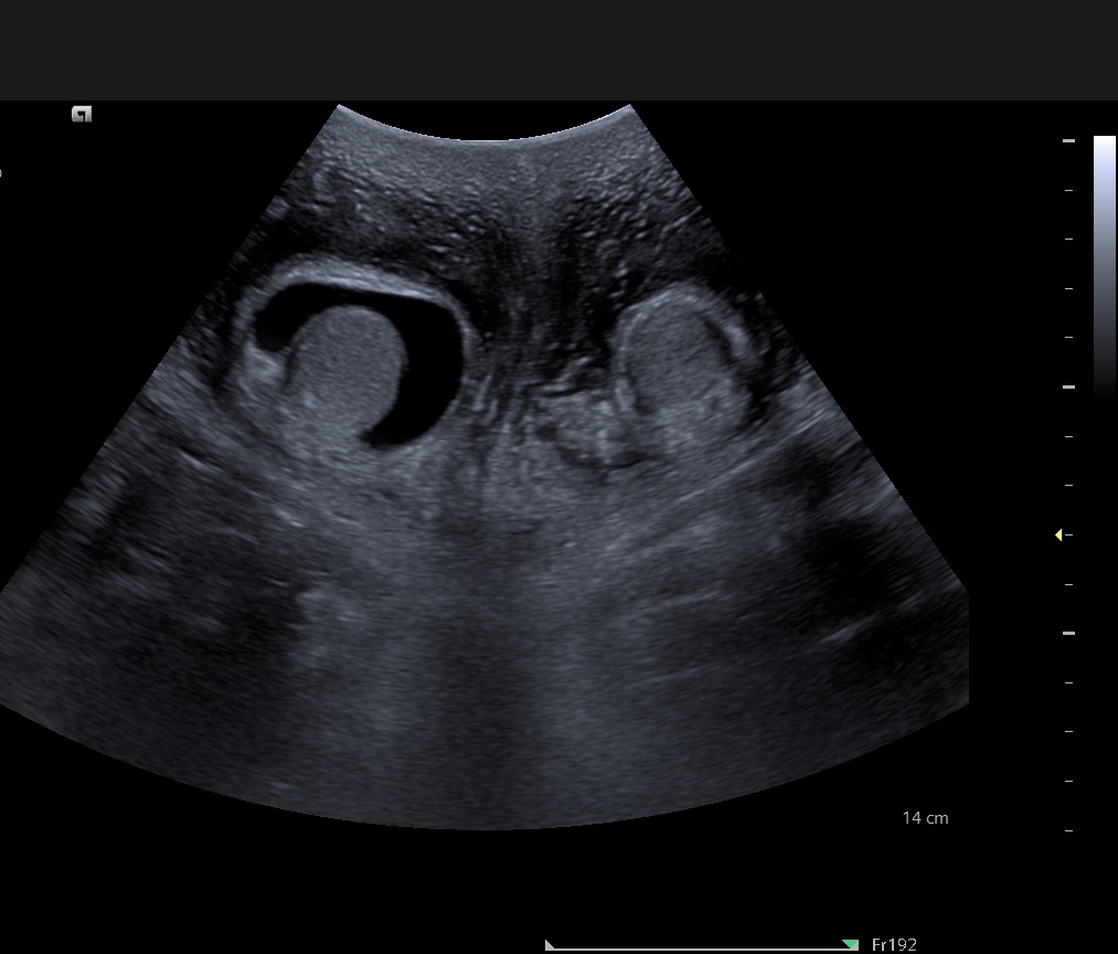 Scrotal cellulitis | Image | Radiopaedia.org